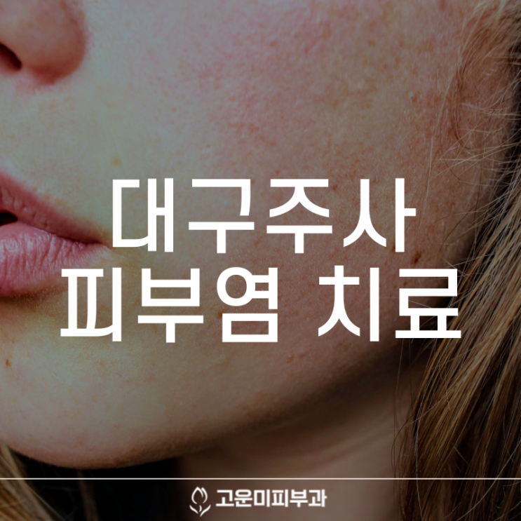  대구주사피부염 얼굴이 쉽게 붉어지고 오랫동안 화끈거리는 증상 조기 진단과 치료가 중요합니다