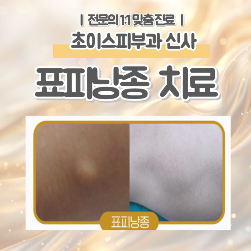 강남 표피낭종 원인, 증상, 치료 방법은?