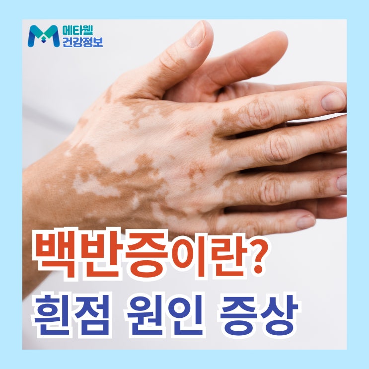  얼굴과 온 몸에 흰색 반점이 늘어나는 백반증 진단, 원인, 증상, 치료방법