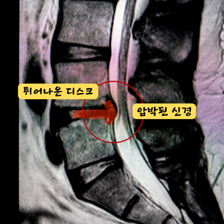  부산서면정형외과, 허리 디스크 비수술 치료의 핵심 원칙 1 가지