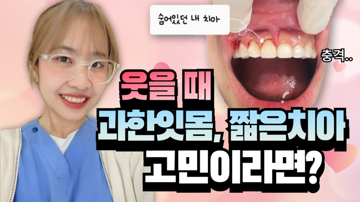  여름휴가 준비, 당일완성 레이저 잇몸성형 후기 비용