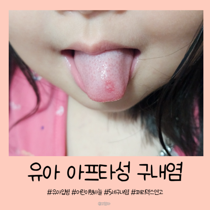 유아 혓바늘 어린이 입병 아프타성 구내염 페리덱스 연고로 해결