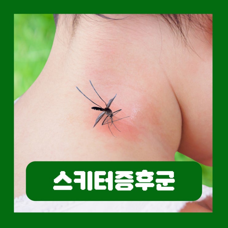  스키터증후군 병원 연고 성인 아기 증상 모기 알레르기