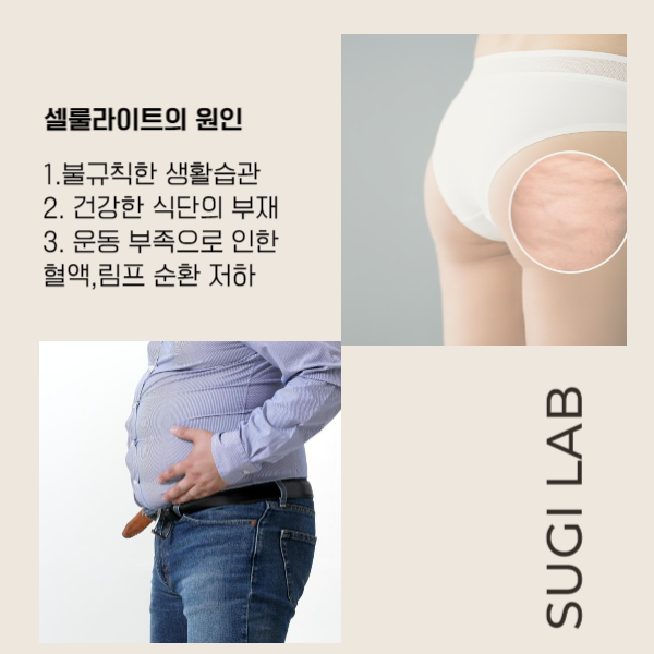  셀룰라이트 제거 10년 차 체형관리 전문가가 드리는 조언