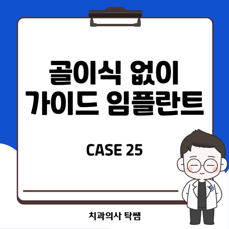  [탁쌤 CASE 25] 청주 골이식 없이 가이드 임플란트