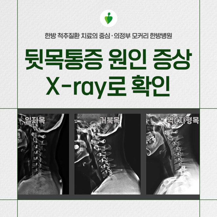  의정부역한방병원 뒷목통증이 발생하는 원인과 동반되는 증상, X-ray를 찍어봐야 하는 이유
