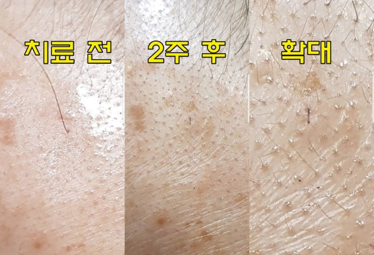  남자 M자형 탈모 원인 및 치료방법, 전주 마벨 후기