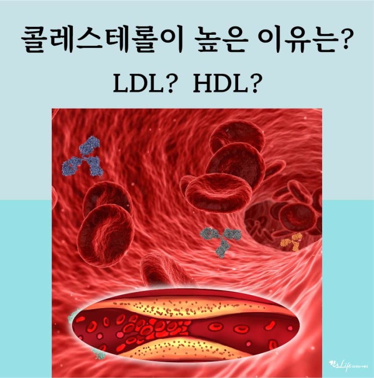  날씬한데 콜레스테롤 높은 이유가 뭘까요?