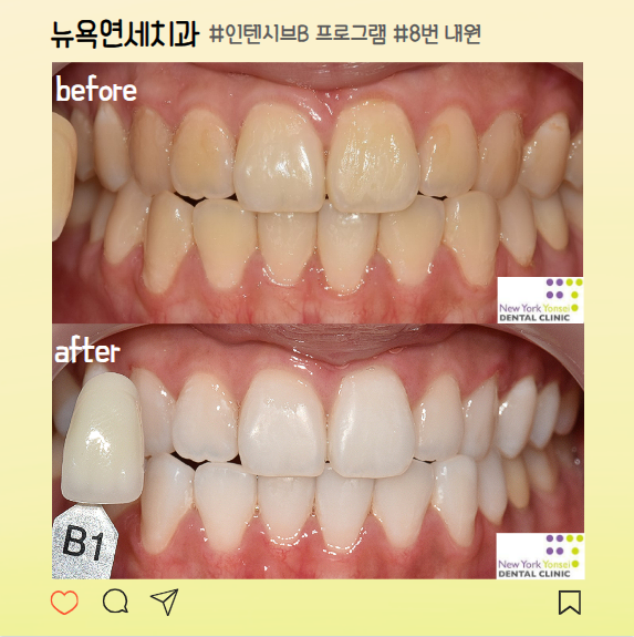  강남역치아미백 전문치과 만족도 높은 결과