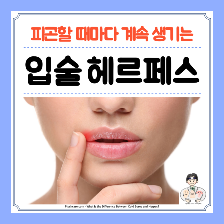  입술 헤르페스 포진, 원인 증상 치료 연고 전염 성병