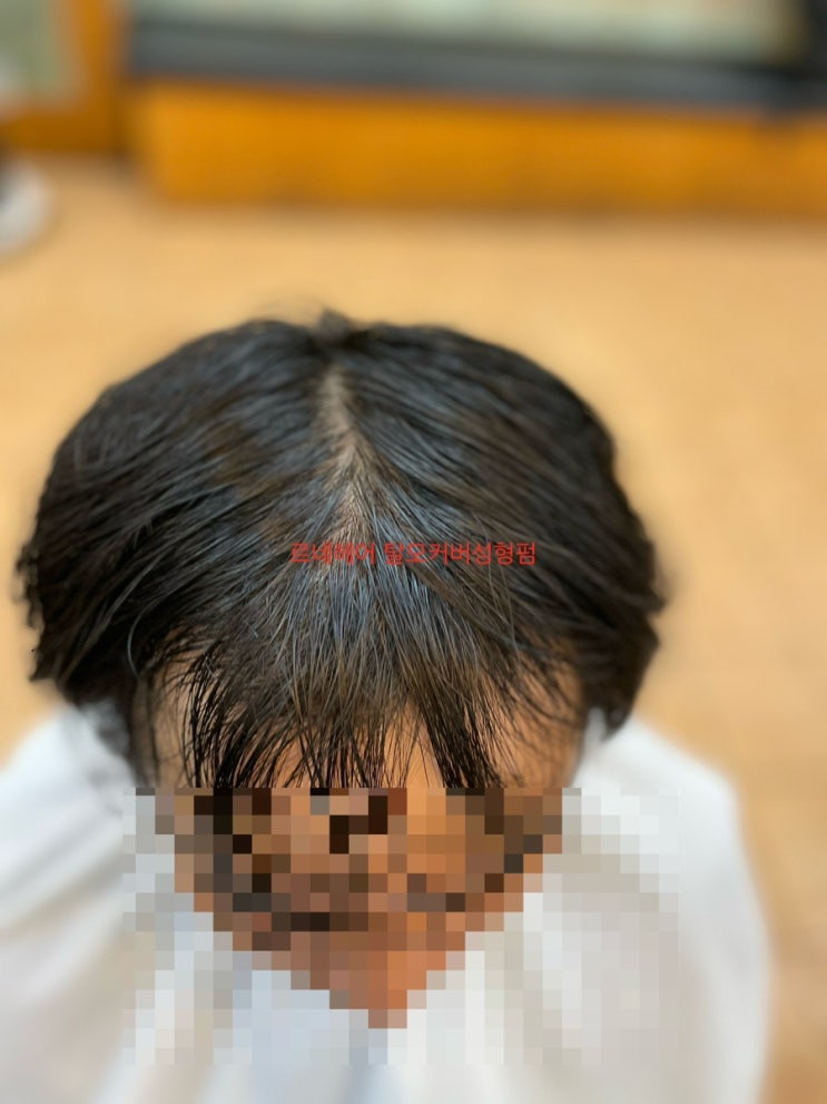  M자탈모O자탈모 정수리탈모는 탈모성형펌시술후 완전히달라진헤어스타일 부산사상르네시떼6층미용실완전추천/ 동래연산김해거제명륜금정장전안락초량범일전포당감주례해운대광안리수영민락센텀용호장안