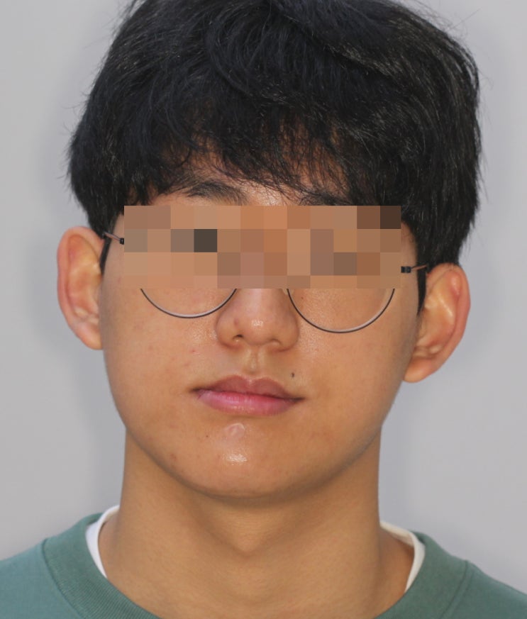  안면 비대칭 교정 후기, 양악 수술 대신 한 17세 남아 진료기록