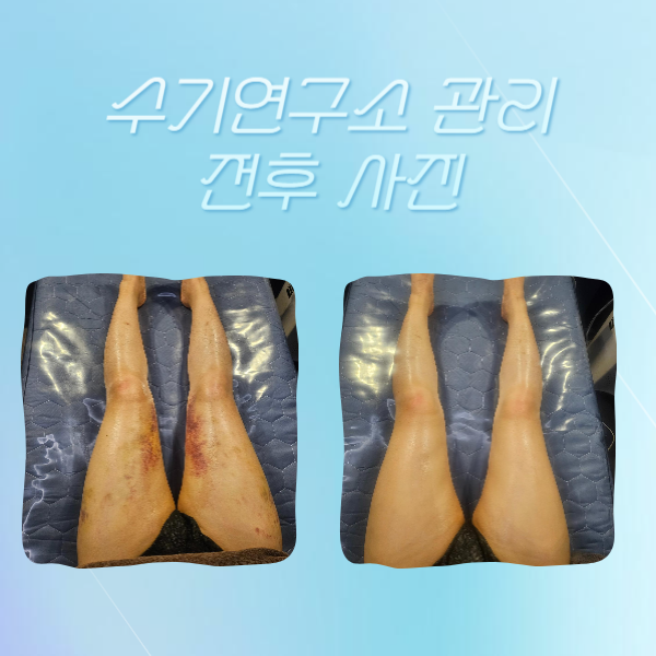  지방흡입 바이오본드 수술 후 사이즈 차이 없는 이유 알려드립니다.