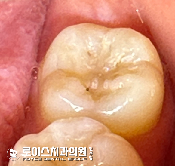  진주로이스치과 "충치치료 완벽 가이드, 건강한 치아를 지키는 방법"