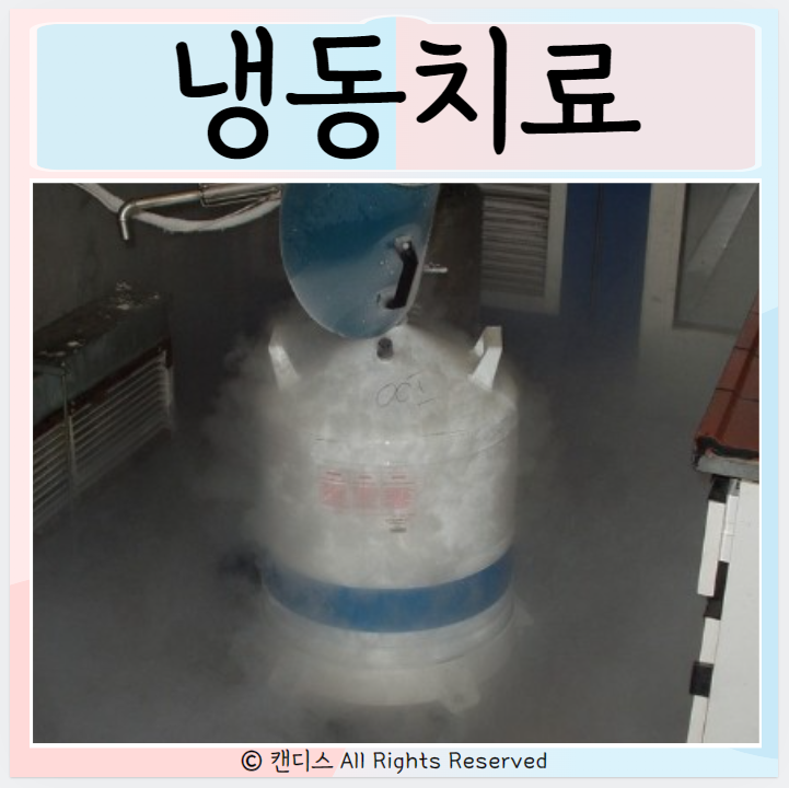  냉동치료 질환 사마귀 티눈 치료방법 장점과 단점