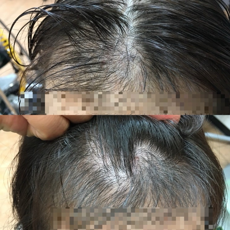  두피탈모관리와 남/여 탈모커버스타일펌 컬렉션 부산넘버원헤어케어르네시떼6층미용실/ 김해가야덕천양산울산진해창원마산진주밀양경주거제경남경북주례감전남포남천용호민락센텀동래사직금정반송영도전포