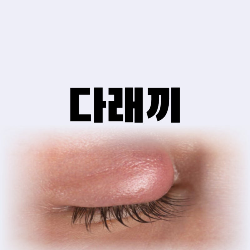 눈 밑 다래끼 속다래끼 초기 증상 전염성 얼마나 강할까(종류)