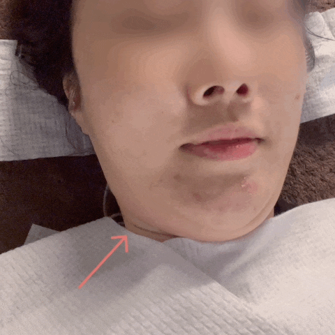  강남피부관리 르보아 더 강남 이중턱라인젯 윤곽케어 후기