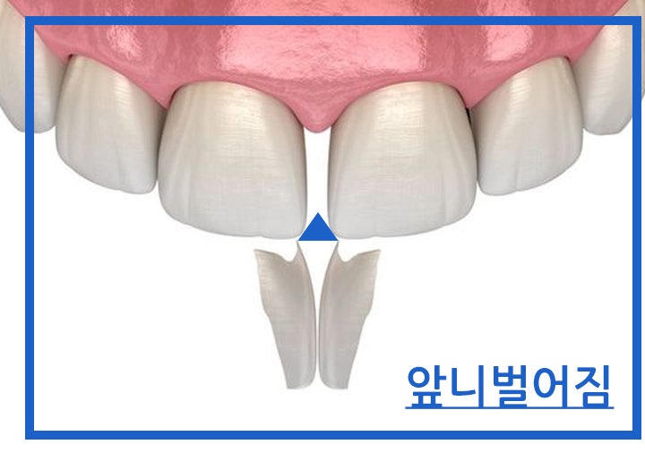  평택 앞니벌어짐 치과에서 레진 하나로 오래