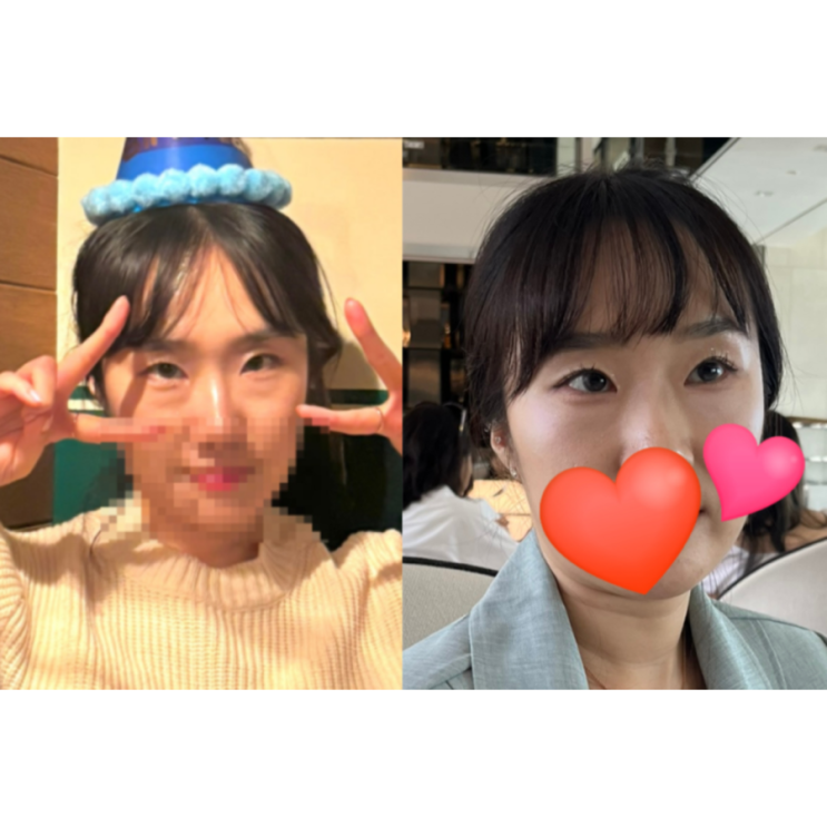  강남 눈밑지방재배치 레이저 반달주사 한달차 가격, 후기 (다운타임 없음)