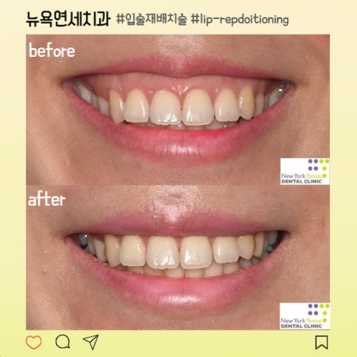  여름휴가 잇몸성형 부작용 걱정 없이 진행
