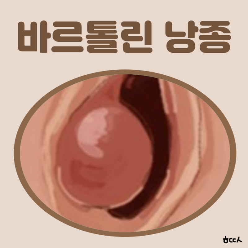 바르톨린 낭종 원인 바르톨린 낭종 자연치유 연고 조대술 수술 재발 치료