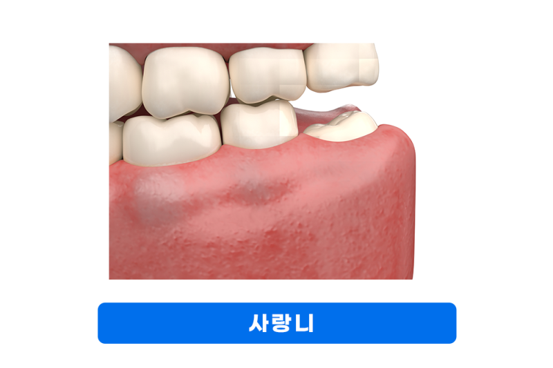 사랑니발치 후 지혈 솜 거즈 교체