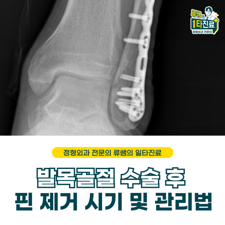  발목 골절 수술 후 3년만에 핀제거 수술 후 관리법 (의사작성)
