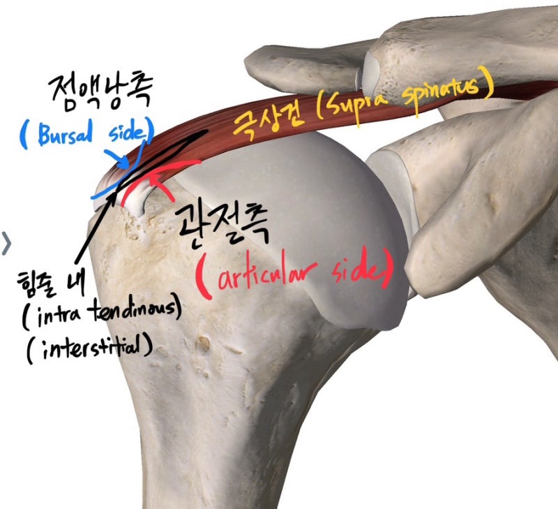 [회전근개 부분 파열]#1 회전근개 부분 파열(rotator cuff partial tear) 분류하는 방법 + 수술이 필요한 ...