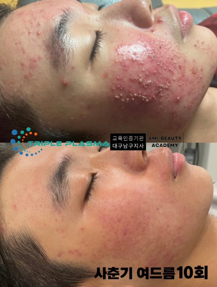  대구 콜드플라즈마로 화농성여드름  블랙헤드 화이트헤드 여드름 없이 깨끗한 피부 만들기!