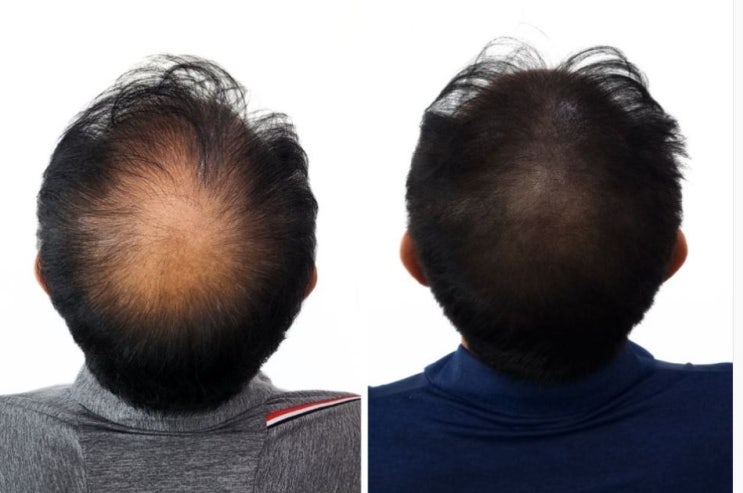  두피SMP 잘하는 곳 5회차 후기, 비용, 기간, 통증 등