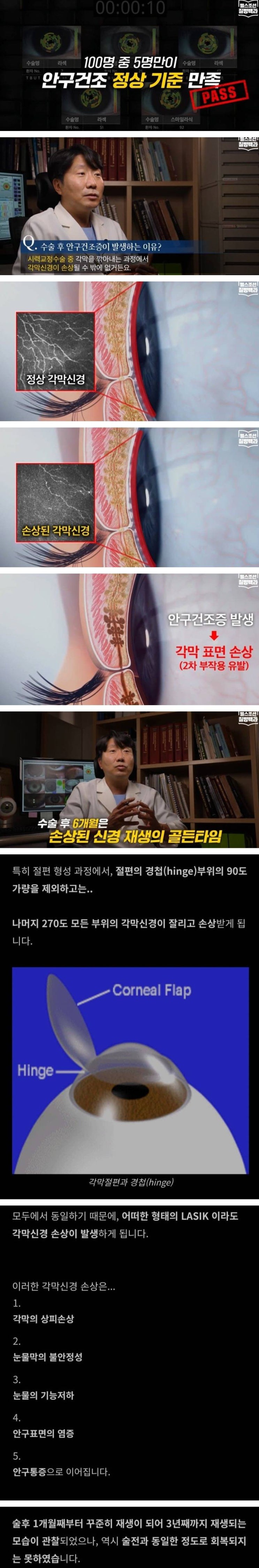  라식 라섹하면 안구건조증 생기는 이유