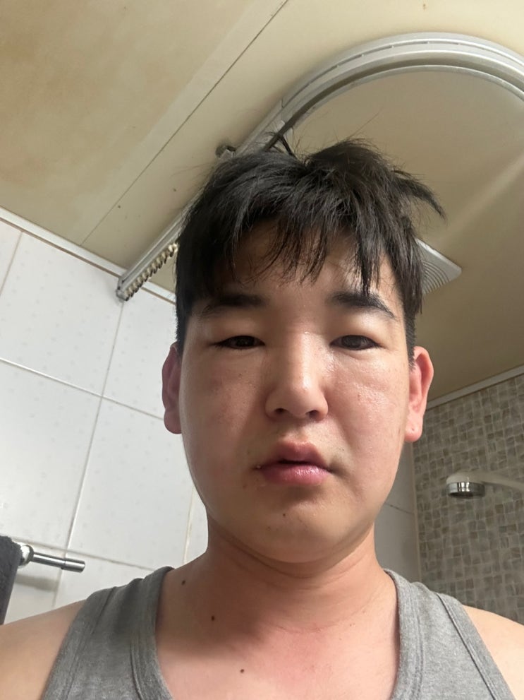  피부가 엄청 따갑고 얼굴이 붉고 왕창 붓는다면?? 접촉성 피부염 후기 완치 병원 피부과 부산 증상 약