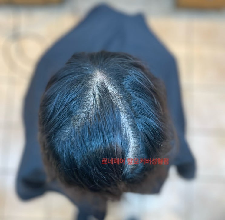  여성탈모 가르마갈라짐 모류교정 시술성지 부산사상르네시떼6층헤어샵 / 김해대저화명덕천모라하단백양명지다대감전주례덕포괘법당감개금부전전포사직동래해운대광안리수영망미남천용호동기장정관울산양산