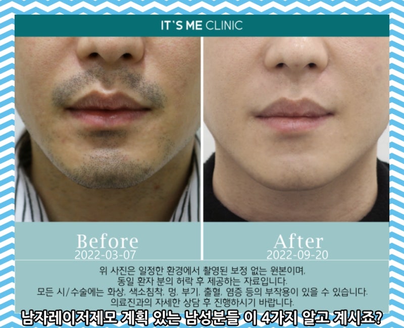 동탄수염제모를 계획하고 계시다면 이 5가지만 알아두세요.
