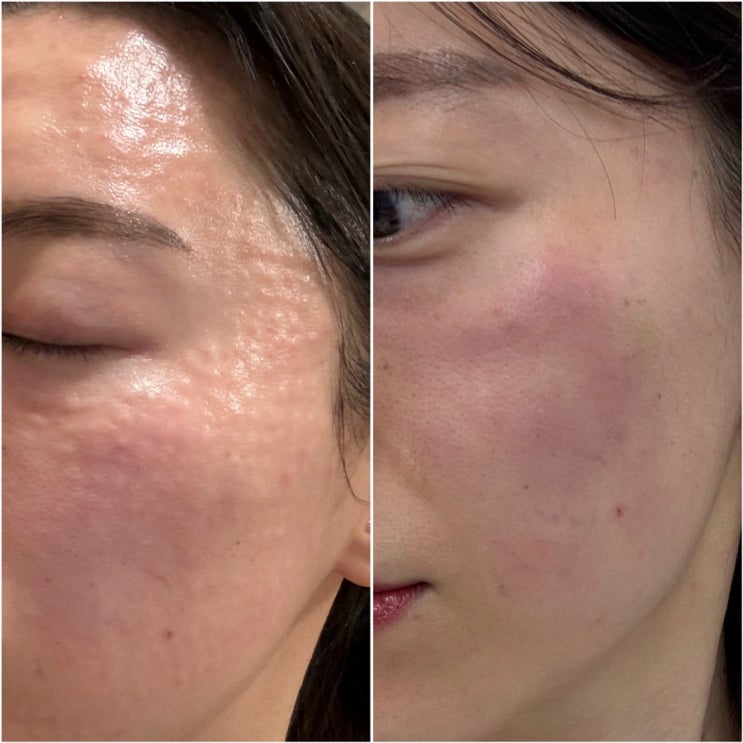 리쥬란힐러 엑소힐러 스킨부스터 부작용 및 후기