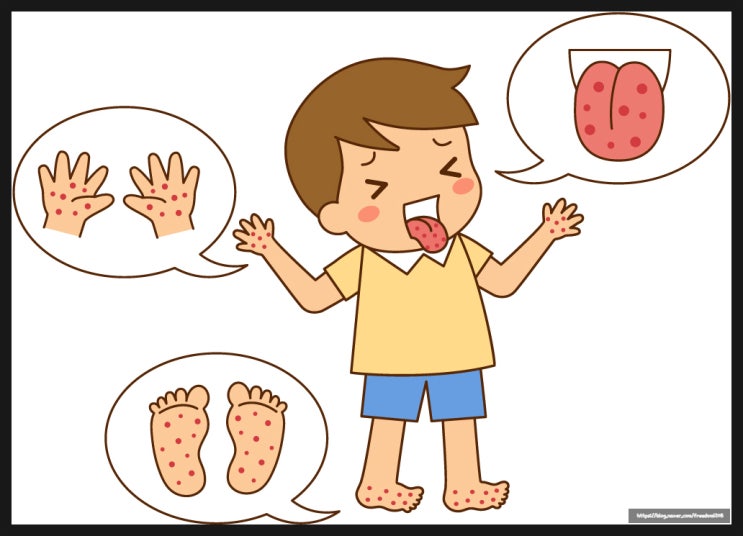  수족구 검사 진단 잠복기 증상 빨리 낫는 법 예방법 가정보육기간