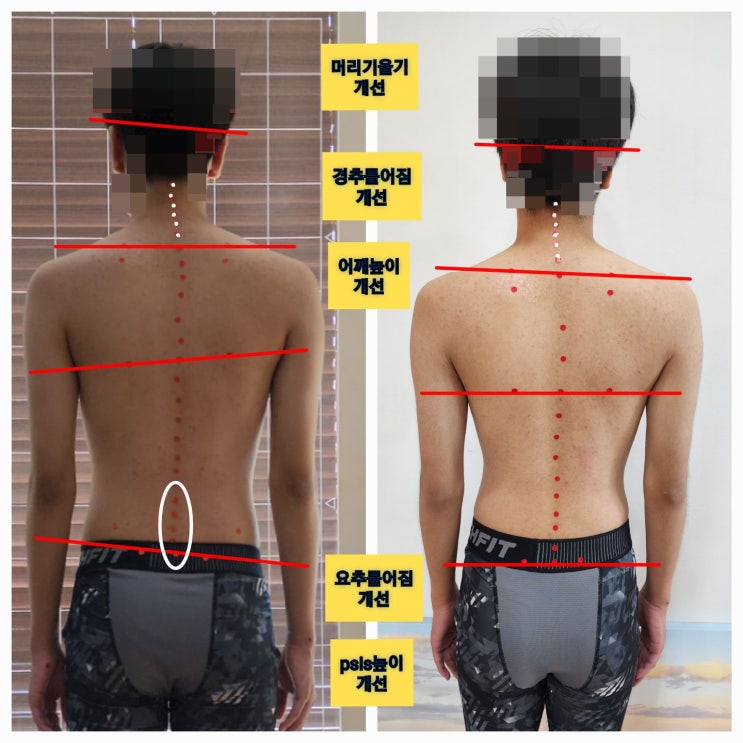  부산 동래 편두통 치료 머리가 아파 뇌수술까지 받으신 회원님 경추교정 후기