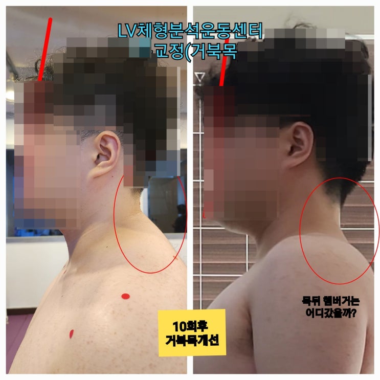  부산 사직동 체형교정 LV체형분석운동센터 거북목 교정 후기