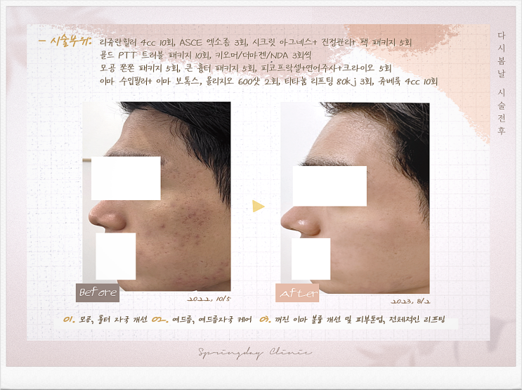  마곡피부과 골드 PTT 가격 후기 체크