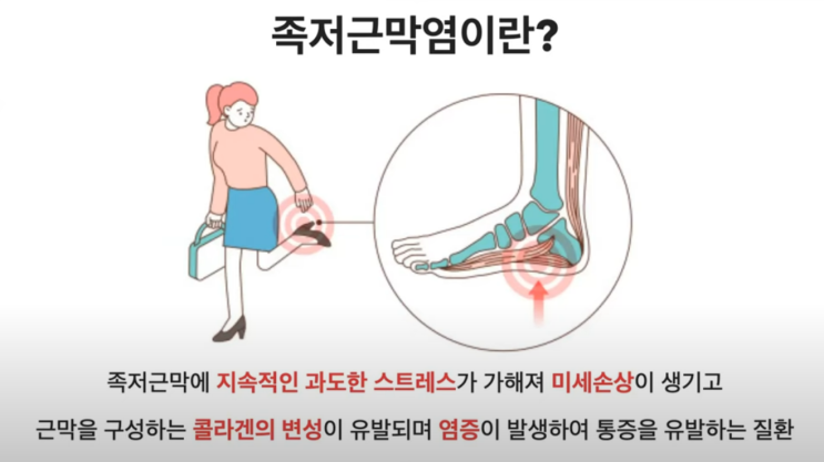  [건강tip] 무지외반증, 족저근막염의 원인과 관리 방법(자고 일어나 첫 발 내딛기가 무서워요)