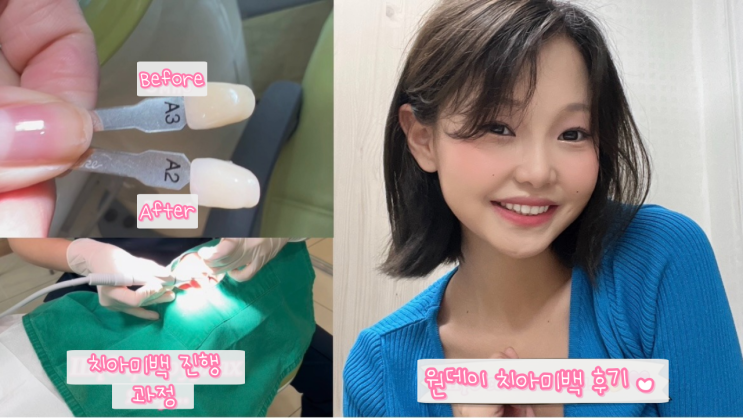  강남역 치과 치아미백 추천 3회 솔직 후기