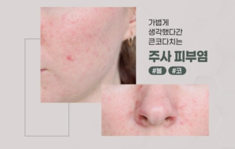 [주사피부염 치료 3탄] 이제 거의 나은 듯해요. LDM홍조 및 시술 후기 : 네이버 블로그