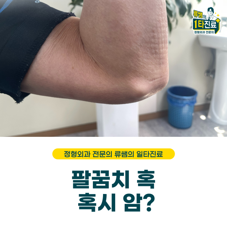  갑자기 생긴 팔꿈치 혹/ 혹시 암?/재발 이유. (의사작성)