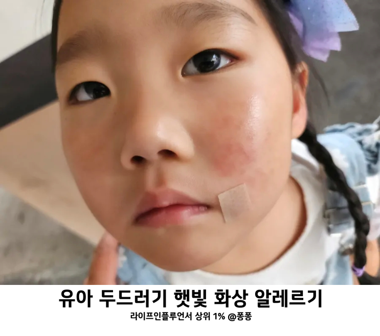  햇빛 화상 햇빛 알레르기 증상 아기 유아 어린이 얼굴 팔 전신 두드러기