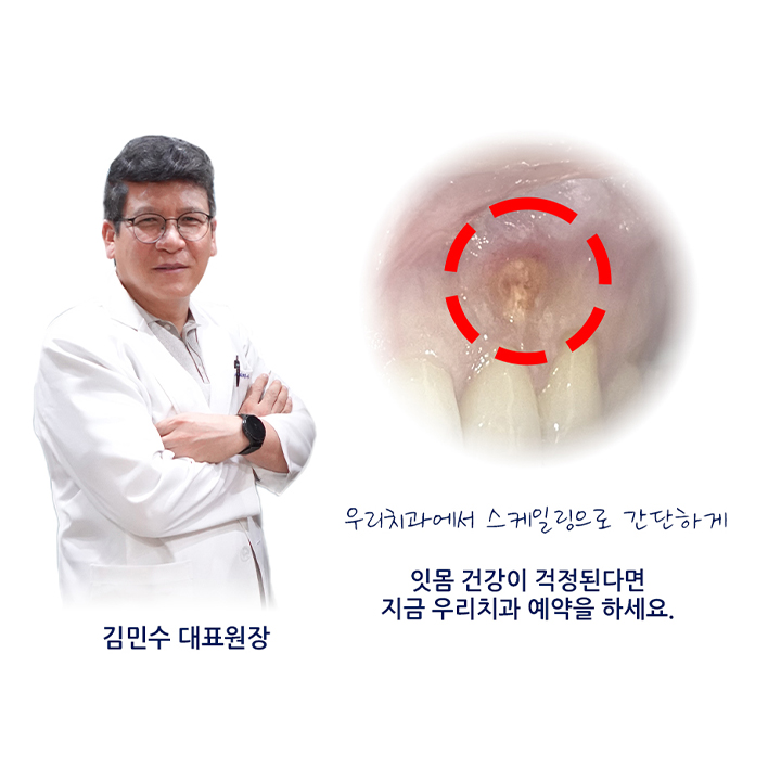  잇몸고름주머니 예방법과 치료가 필요하다면