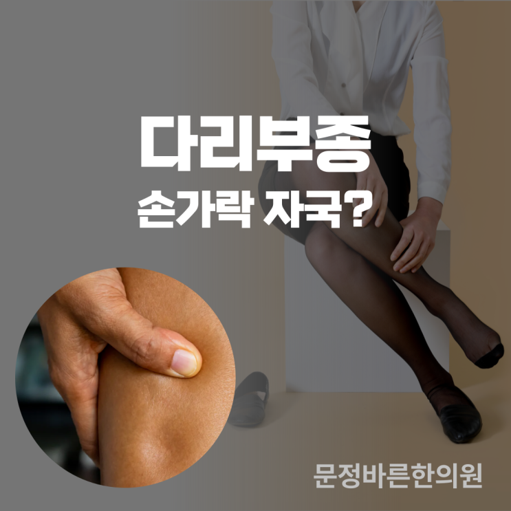 중노년층 다리붓기 치료 사례(방기,황기) 중노년층 다리붓기 치료 사례(방기,황기)