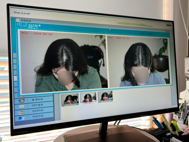  신사역 탈모관리, 아미치0.3 신사점 / 원형탈모 극복, 3개월 탈모관리 받은 후기!(관리 전,후 비교)