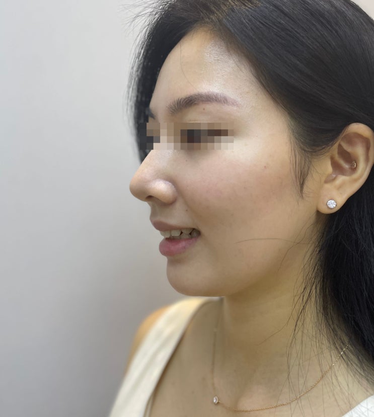  악궁 확장 장치 앞니, 부작용 나고 싶음 절대 읽지 마세요.