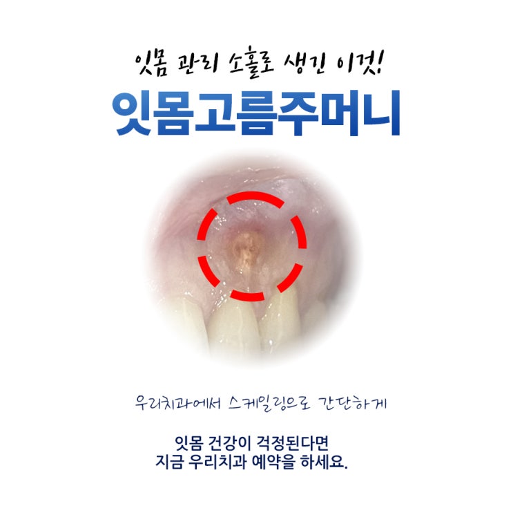  잇몸 고름 농양 염증 혹 주머니 평택치과 가기 전 진단하는 방법